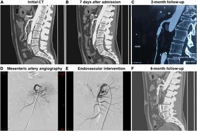 Relationship Between Morphological Remodeling and Angiographic Types of Spontaneous Isolated Superior Mesenteric Artery Dissection After Conservative Management: Determinant Affecting Serial Radiologic Courses